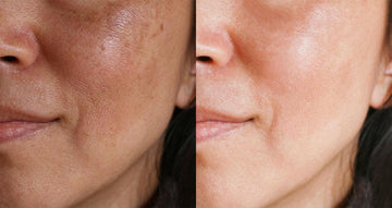 How do you use vitamin C serum for uneven skin tone & dark circles?